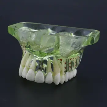 10pieces Zobu Zobu Modelis NISSIN Kilgore Implantu Modelis augšžokļa deguna blakusdobumu Vainagu Tilts Izglītībai